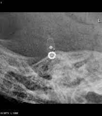 According to the ajnr 2010 article by lollis et al, the codman hakim valve is set at 60 mm water (which is the same as the pre mri setting). Codman Hakim Programmable Vp Shunt Radiology Case Radiopaedia Org