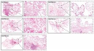 The tumor cells are strikingly similar to normal squamous. Cancers Free Full Text Well Differentiated Papillary Mesothelioma Of The Peritoneum Is Genetically Distinct From Malignant Mesothelioma Html