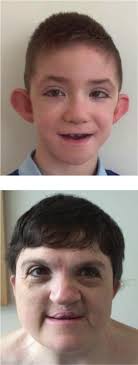 A restricted spectrum of missense KMT2D variants cause a multiple  malformations disorder distinct fromKabuki syndrome