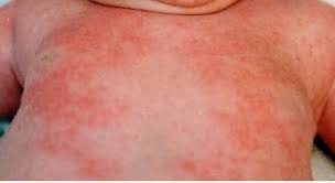 Image result for sweat rash on back baby