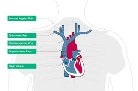 Cvp provides flexibility for container infrastructure design, giving the customer ultimate rule in how they manage the infrastructure. Misplacement And Malposition Of Central Venous Catheters