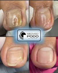 Image result for Onycholysis feet