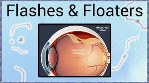 Several parts of the eye are associated with the retina. Flashes Floaters A Sign Of Retinal Detachment Youtube