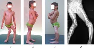 The bacteria often live in a person's upper respiratory tract without causing signs of illness. Orthopaedic Sequelae Of Meningococcemia In Children Options For The Correction Of Lower And Upper Limb Deformities Preliminary Message Garkavenko Pediatric Traumatology Orthopaedics And Reconstructive Surgery