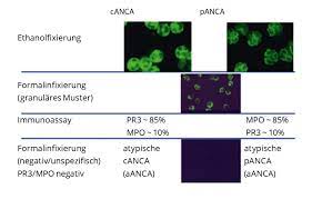 Autoimmun Vaskulitis Anca Paradigmenwechsel Bei Der Anca Bestimmung Trillium Gmbh Medizinischer Fachverlag