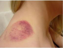 How To Get Rid Of Bruises Overnight Bruises Remedy Home Remedies For Bruises Bruises
