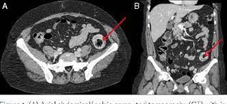 Maybe you would like to learn more about one of these? Figure 1 From Transient Descending Colocolonic Intussusception Due To A Large Fecaloma In An Adult Semantic Scholar