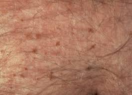 Image result for pubic lice symptoms
