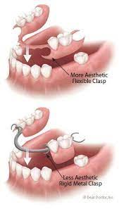 Types Of Flexible Partial Dentures Dental Cosmetics Dental Implants Cost Dental Surgery
