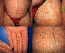 We did not find results for: Acd A Z Of Skin Pityriasis Rubra Pilaris