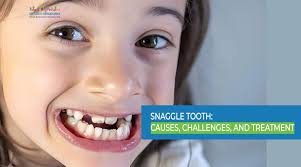 How To Fix A Snaggletooth | Bailey Orthodontics