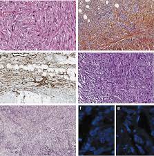 Sarcomatoid mesothelioma accounts for approximately 15 percent of all mesothelioma diagnoses. New Insights On Diagnostic Reproducibility Of Biphasic Mesotheliomas A Multi Institutional Evaluation By The International Mesothelioma Panel From The Mesopath Reference Center Journal Of Thoracic Oncology