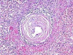 Дифференциальная диагностика счс проводится с гранулематозом вегенера, гиперэозинофильным синдромом, узелковым полиартериитом. Glava 17 Revmatich Bol Poroki