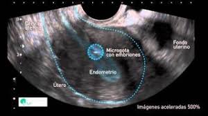 El Reposo Despues De La Transferencia De Embriones El Blog De La Fertilidad