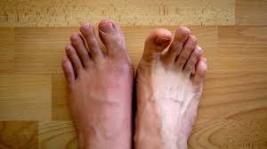 Image result for gout