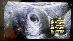 You'll also be told whether you're having twins. What To Expect At Your Six Week Ultrasound Appointment