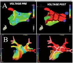 Tuttavia, molti pazienti affetti da fibrillazione atriale sono più anziani e presentano comorbilità come ipertensione e diabete; Ablazione Fibrillazione Atriale Prof Pappone Af Ablation