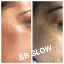 Now choose the nano module and apply bb glow pigment serum. Bb Glow Behandlung Kosmetikstudio Glorie Beauty Lounge In Dortmund