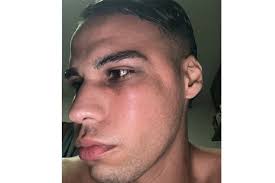 Jugador de Gimnasia y Esgrima agredido en partido con Sportivo Urquiza