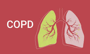 Chronic obstructive pulmonary disease, commonly referred to as copd, is a group of progressive lung diseases. Copd Linked To Increased Risk Of Lung Cancer In Nonsmokers