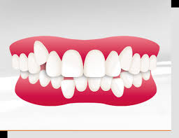 Die Haufigsten Zahnfehlstellungen Uberbiss Kreuzbiss Tiefbiss Kieferorthopadische Praxis Dr Med Dent Peter Borg