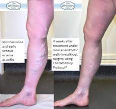 You will be able to walk for a shorter distance after 3 months without any additional support. Walk In Walk Out Varicose Vein Surgery The Whiteley Clinic