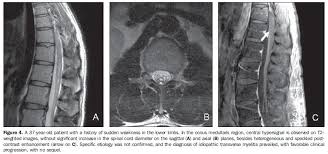 They most commonly affect elderly men and are classically found in the thoracolumbar region. Scielo Brasil Diagnostico Diferencial Das Lesoes Inflamatorias E Infecciosas Do Cone Medular Utilizando A Ressonancia Magnetica Diagnostico Diferencial Das Lesoes Inflamatorias E Infecciosas Do Cone Medular Utilizando A Ressonancia Magnetica