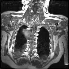 Lung cancer pain in back. When Back Pain Turns Deadly An Unusual Presentation Of Lung Cancer Sciencedirect