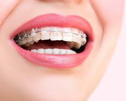 Promotional financing options are not available at all retail locations that accept carecredit and standard account terms will apply to such purchases. Medicaid Orthodontist Colorado Orthodontic Experts Colorado