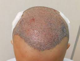 È fondamentale evitare qualsiasi attività sessuale durante i primi 2 giorni post intervento. Foto Trapianto Capelli Prima E Dopo Masullo Medical Group