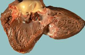 Hasil gambar untuk endocarditis