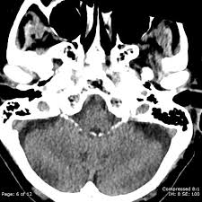 Bochdalek S Flower Basket Radiology Case Radiopaedia Org In 2020 Flower Basket Flowers Plexus Products