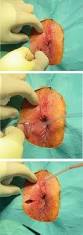 Image result for Perianal Abscess
