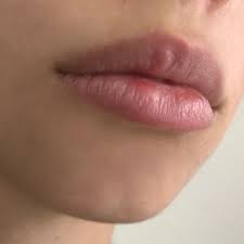 Denn im gegensatz zu anderen knoten wird das überstehende schnurende (in diesem Ist Das Herpes Knubbel Auf Der Lippe Gesundheit Und Medizin