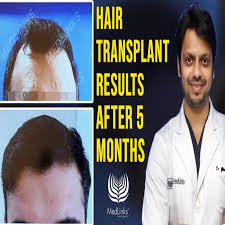 The article highlighted the different aspects of hair transplant. Hair Transplant Case Study Best Hair Transplant Results In India After 5 Months Listen Notes