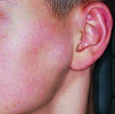 Lymphknotenhyperplasie Im Bereich Der Glandula Parotis Zm Online