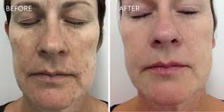 Hyperpigmentation can also be termed as dyschromia in some cases the treatment of melasma on face may begin with a biopsy. What To Expect After Laser For Pigmentation Australian Skin Clinics