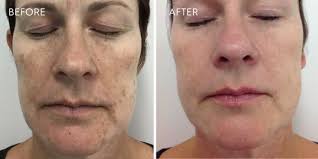 What To Expect After Laser For Pigmentation Australian Skin Clinics