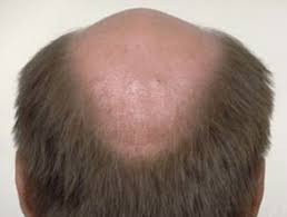 Chin hair in females is relatively common. Male Pattern Hair Loss Dermnet Nz