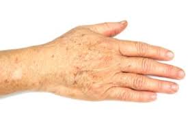 Sun spots on skin black spots on face brown spots on hands spots on legs dark spots getting rid of freckles how to remove freckles freckle remover sunspots on face. Age Spots Treatments Stockton Dermatology