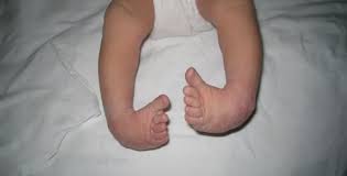 Image result for Clubfoot