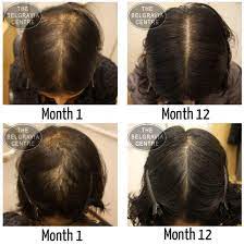 I frequently use cortisone injections to stop or reduce inflammation under the scalp in many hair loss conditions. Could Changing Your Job Help Prevent Hair Loss