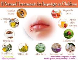 11 Natural Treatments For Impetigo In Children Impetigo Natural Treatments Essential Oils For Kids