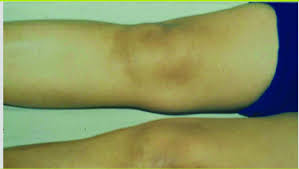 Aperçu l'érythème migrant est la lésion initiale de la maladie de lyme et apparaît souvent au site de la piqûre de tique infectante. La Borreliose De Lyme De L Erytheme Migrant A L Arthrite De Lyme