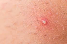 Ingrown hair is when a hair follicle grows into the skin and does not come out of it and it irritates the skin and creates bumps. How To Use Essential Oils To Prevent And Treat Ingrown Hair Essential Oil Benefits