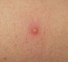 Bug Bite Black And Blue Ring Folliculitis Wikipedia