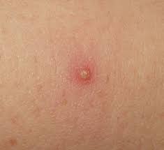 In terms of appearance, an ingrown hair forms a bump that could look like a pimple. Folliculitis Wikipedia
