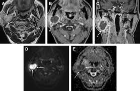 Image result for Sialoadenitis