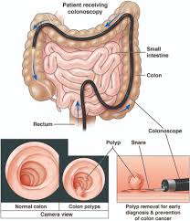 Image result for Colon Cancer Screening with Colonoscopy