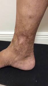 Image result for Lipodermatosclerosis